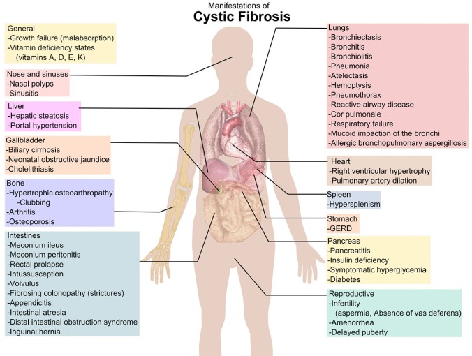 Cystic_fibrosis_manifestations